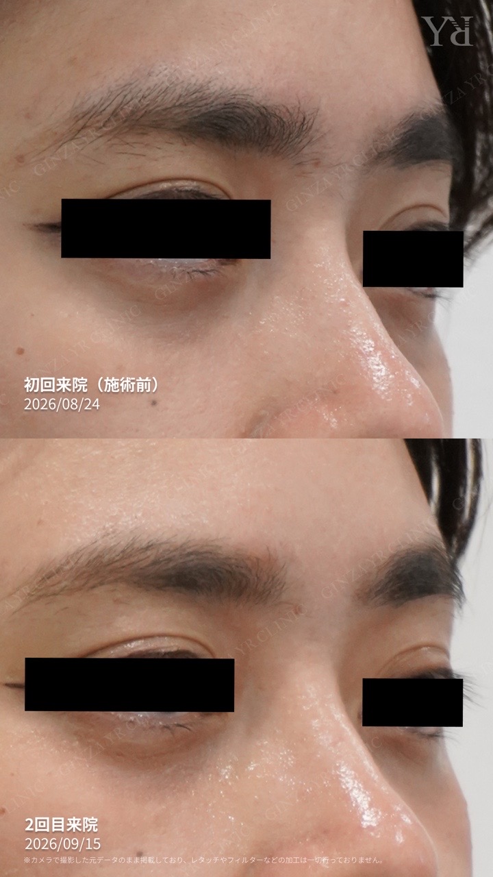 SUNEKOS眼周ケア：初回から2回目来院までの記録